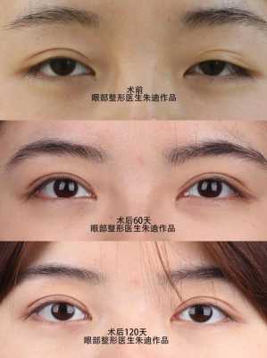 怎么做韩式双眼皮手术价格（韩式双眼皮大概多少钱）