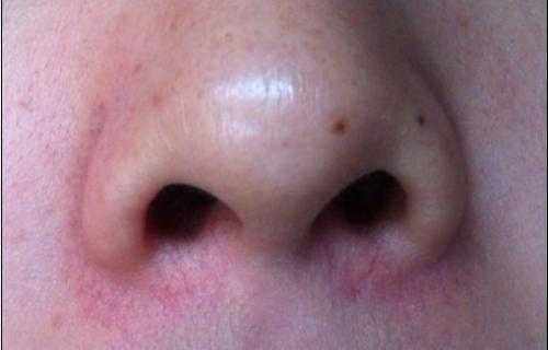 激光治疗红血丝鼻子（激光治疗红鼻子危险吗）
