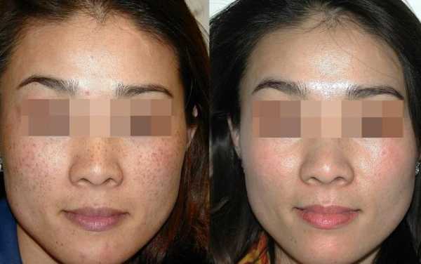 脸上长斑用激光可以去掉吗（脸上有斑用激光对皮肤伤害是不是很大）