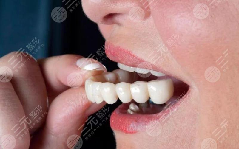 修补牙齿的价格（修补牙齿多少钱一个）