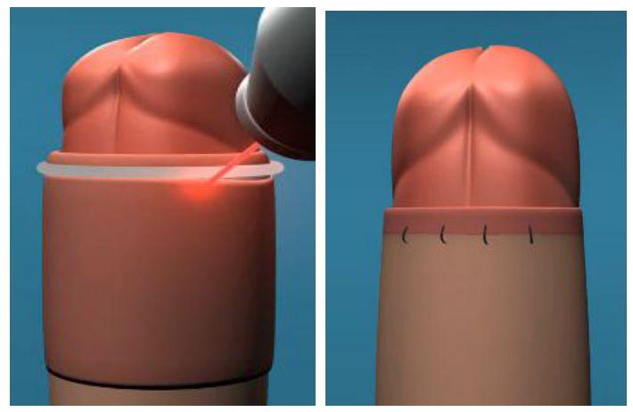 激光割包皮手术过程（激光割包皮手术过程图）
