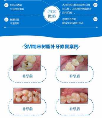 3m树脂牙价格（3m树脂牙价格表）