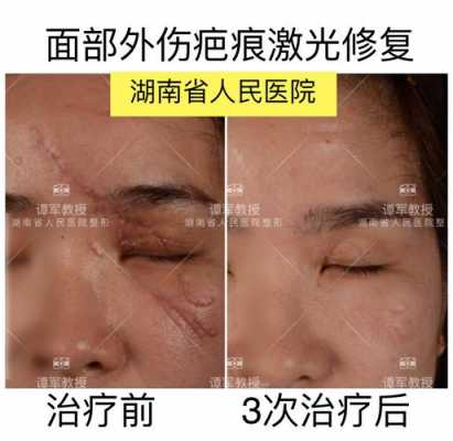 皮肤激光预防疤痕（皮肤激光预防疤痕吗）