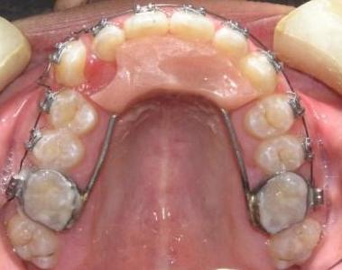 牙齿矫正的导板价格（矫牙导板多长时间适应）