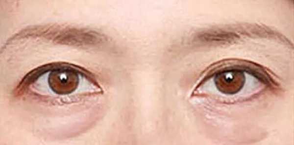 激光祛眼袋有副作用吗（激光去眼袋对眼睛有伤害吗）