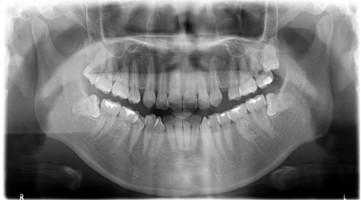 牙科曲面断层价格（牙曲面断层片和正常牙片区别）
