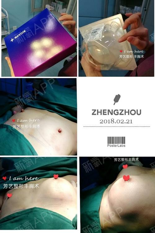 上海隆胸修复价格多少（上海隆胸手术恢复时间）